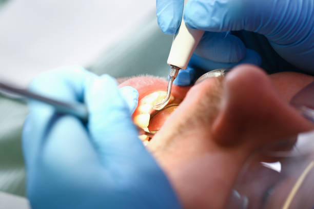 Best Emergency Wisdom Teeth Removal in Greentown, OH